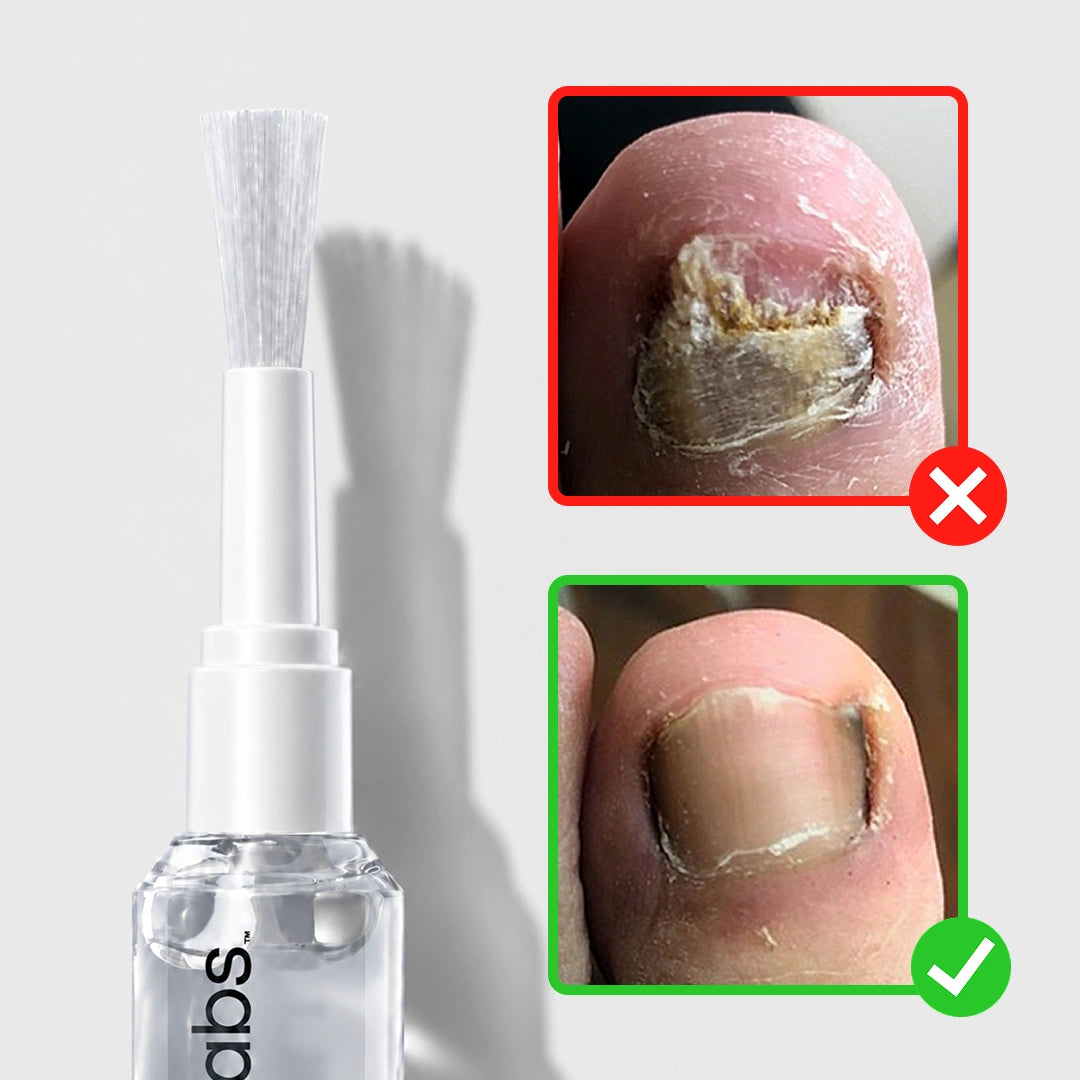 SoleraLabs™ Anti Fungus Treatment Pen